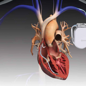 Schmerzfrei leben mit implantiertem Defibrillator